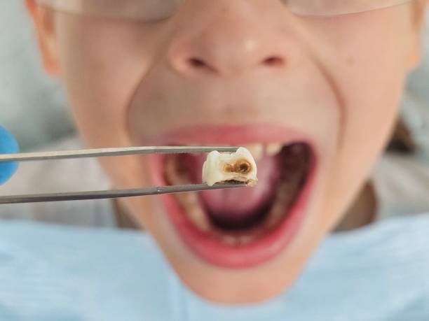 Best Emergency Broken Tooth Repair in Caledonia, MS